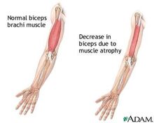 Muscular-dystrophy