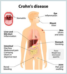 Crohns disease dp