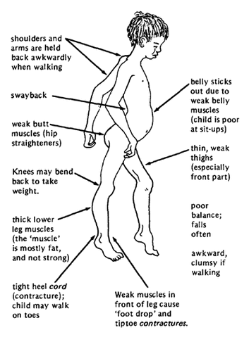 File:Duchenne-Muscular-Dystrophy.gif