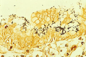 Pylorigastritis