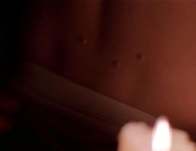 File:Mosquito bites.jpg