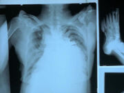 NephilimXRay